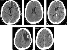 Immuno-molecular features and therapeutic implications of brain metastases in clear cell renal cell carcinoma patients