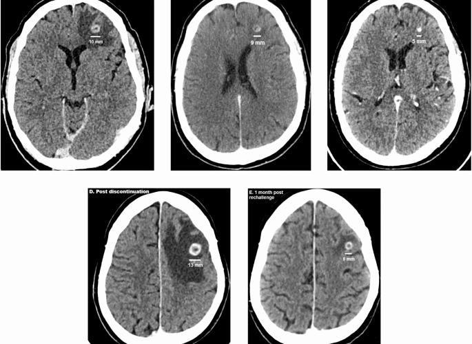 Immuno-molecular features and therapeutic implications of brain metastases in clear cell renal cell carcinoma patients