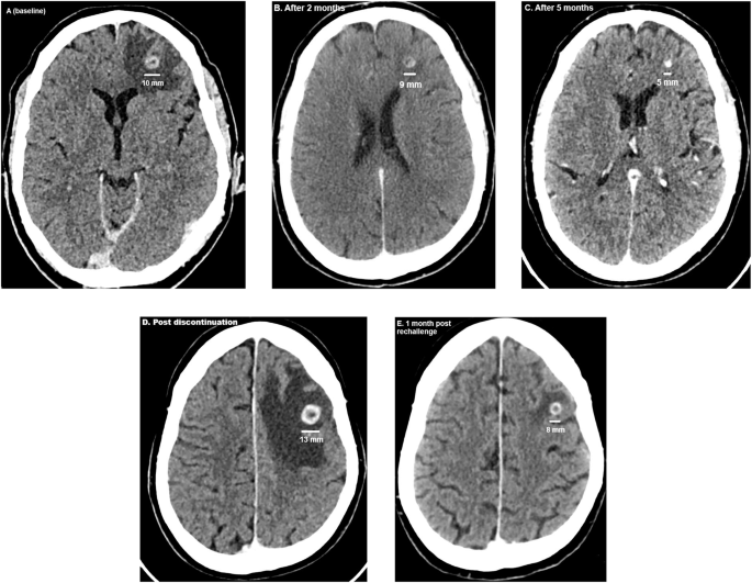 Immuno-molecular features and therapeutic implications of brain metastases in clear cell renal cell carcinoma patients