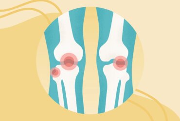 Knee Osteoarthritis