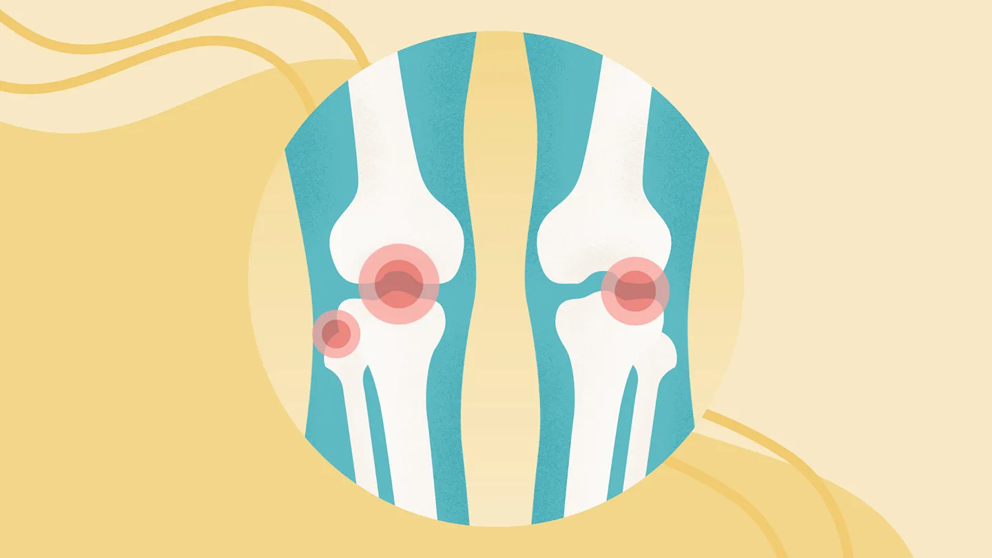 Knee Osteoarthritis