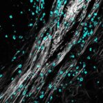 Macrophages restrict tumor immune infiltration by controlling collagen topography | Science Immunology