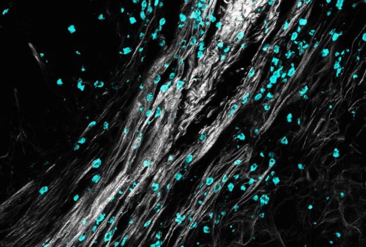 Macrophages restrict tumor immune infiltration by controlling collagen topography | Science Immunology
