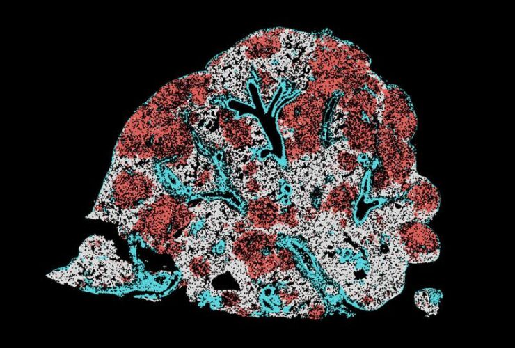 Modulating AP-1 enables CAR T cells to establish an intratumoral stemlike reservoir and overcomes resistance to PD-1 blockade | Science Immunology