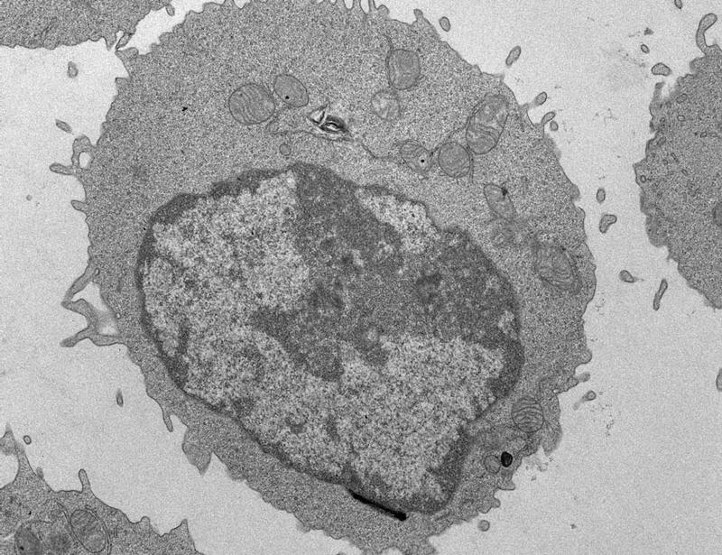Palmitate-induced mitochondrial damage restricts histone acetylation in CD8 T cells to impair antitumor immunity | Science Immunology
