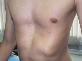 Pectus Excavatum Exercises