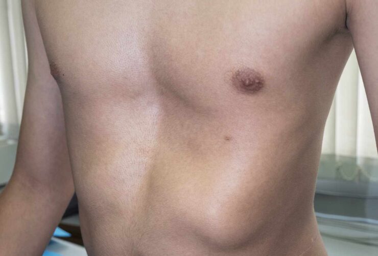 Pectus Excavatum Exercises