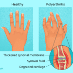 Polyarthritis: Symptoms, Causes, Diagnosis, Treatment