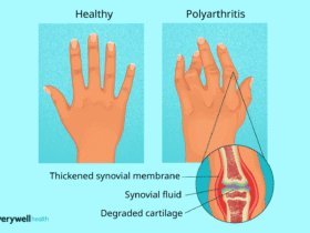 Polyarthritis: Symptoms, Causes, Diagnosis, Treatment