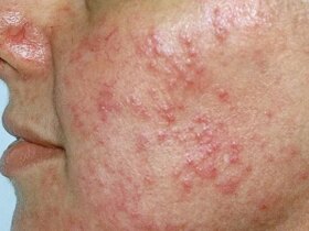Is It Rosacea or Something Else?
