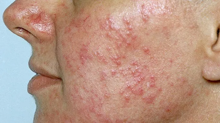 Is It Rosacea or Something Else?