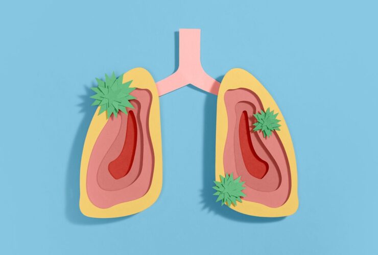 Severe Flu or COVID-19 Could Raise Lung Cancer Risk