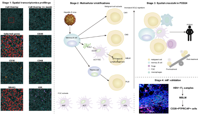 Spatial profiling uncovers multicellular dynamics in early relapse of hepatitis B virus-associated follicular lymphoma