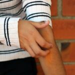 Symptoms of Skin Crawling and How It's Treated