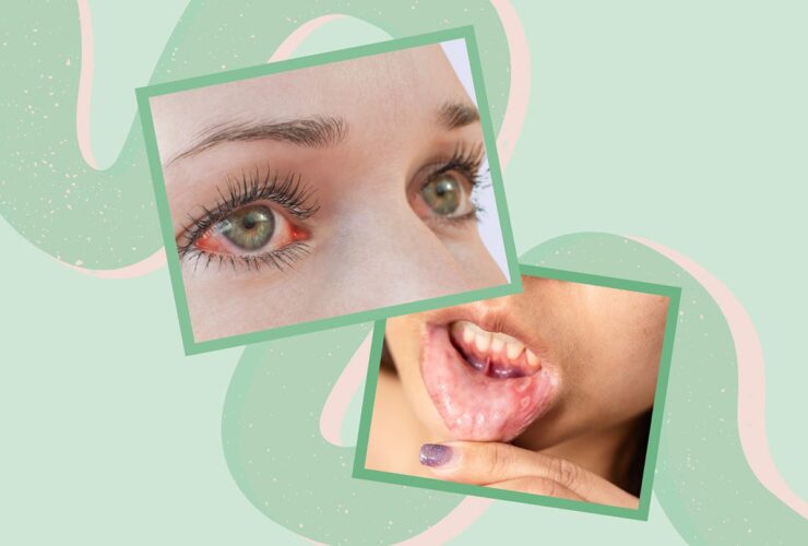 6 Unexpected Signs That Your Crohn’s Is Getting Worse