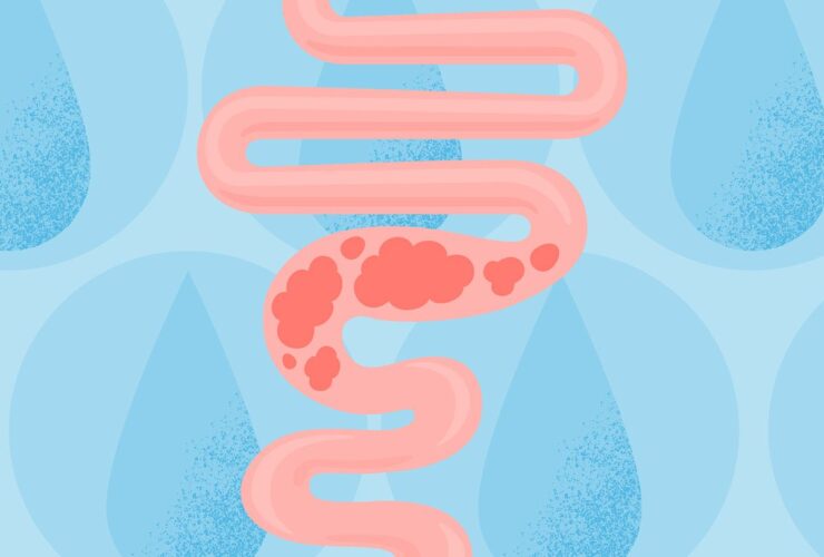 Water for Constipation: Does It Work?