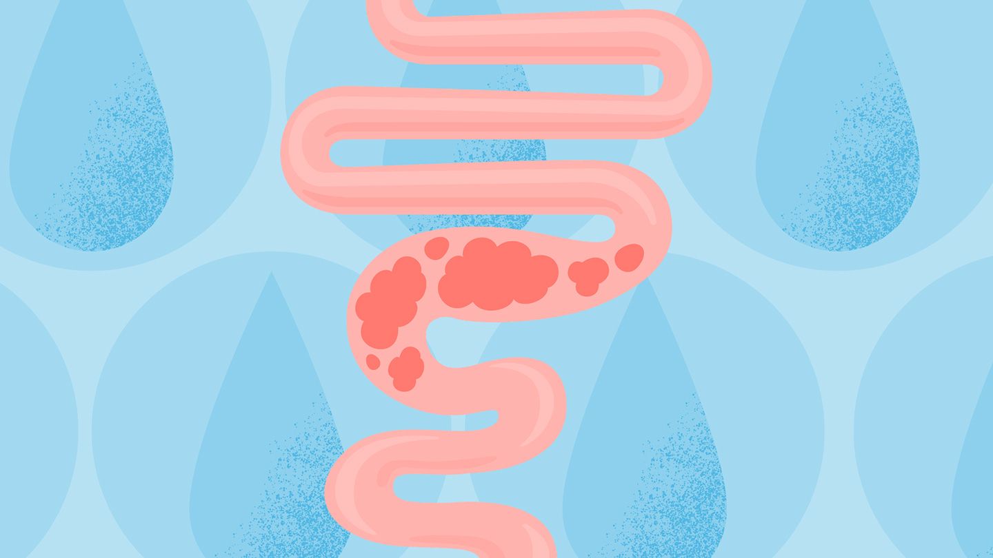 Water for Constipation: Does It Work?