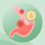 What Are Peptic Ulcers?