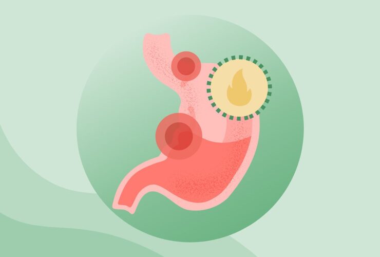 What Are Peptic Ulcers?