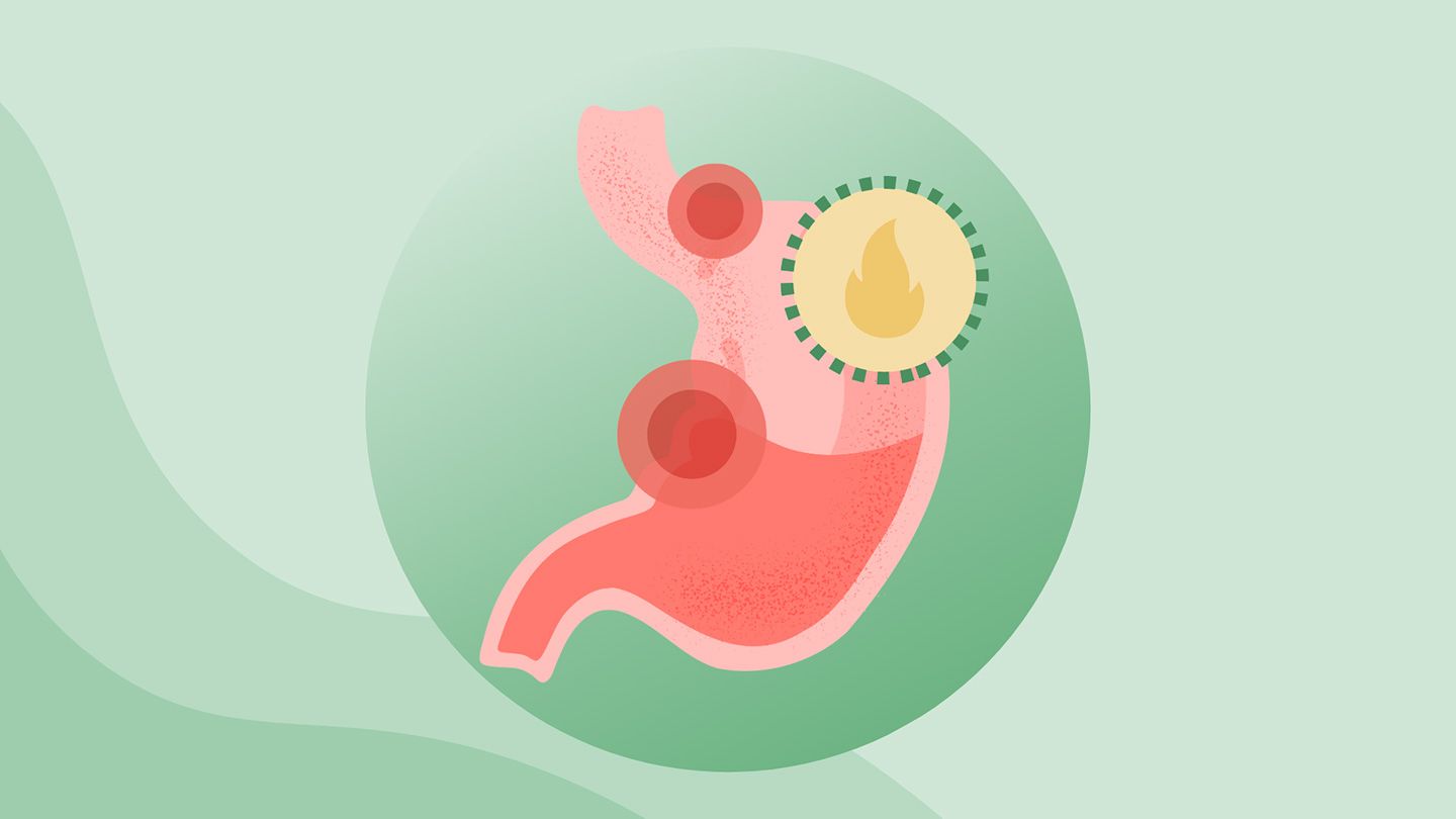 What Are Peptic Ulcers?