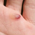 What Causes Blood Blisters and How Do You Get Rid of Them?