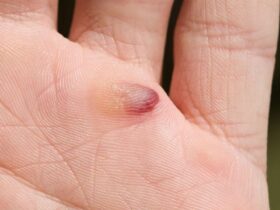 What Causes Blood Blisters and How Do You Get Rid of Them?