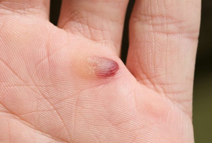 What Causes Blood Blisters and How Do You Get Rid of Them?