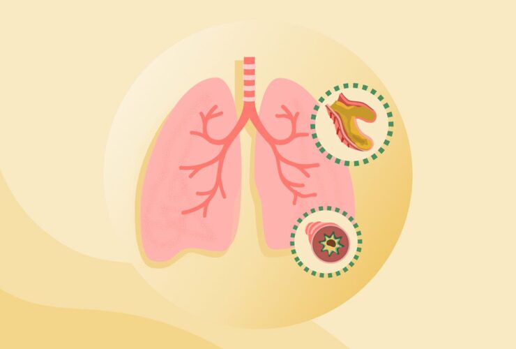 What Is Bronchiectasis?