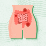 What Is Constipation?