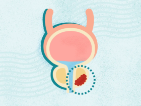 What Is Prostate Cancer? Symptoms, Stages, Diagnosis, Treatment, and More