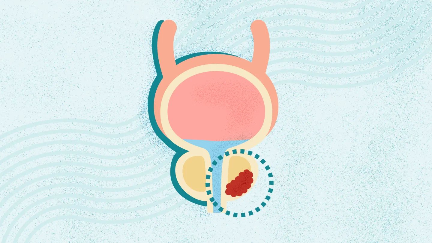 What Is Prostate Cancer? Symptoms, Stages, Diagnosis, Treatment, and More