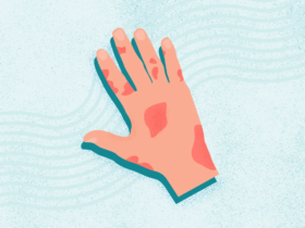 What Is Psoriatic Arthritis?