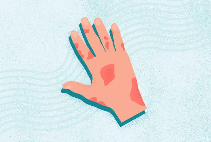 What Is Psoriatic Arthritis?