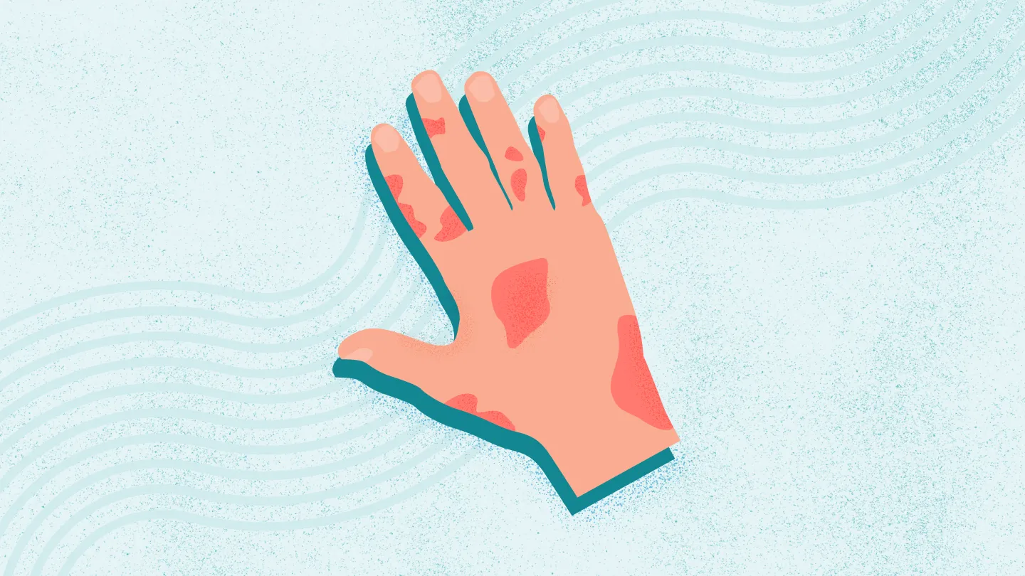 What Is Psoriatic Arthritis?