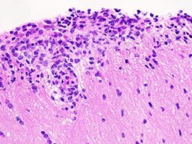 An adaptive cellular source of IL-17A and IL-17F is critical for the induction of experimental autoimmune encephalomyelitis | Science Immunology
