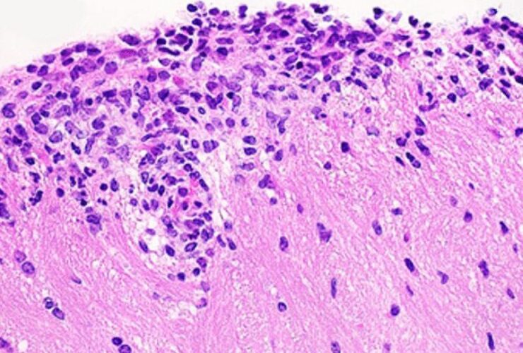 An adaptive cellular source of IL-17A and IL-17F is critical for the induction of experimental autoimmune encephalomyelitis | Science Immunology