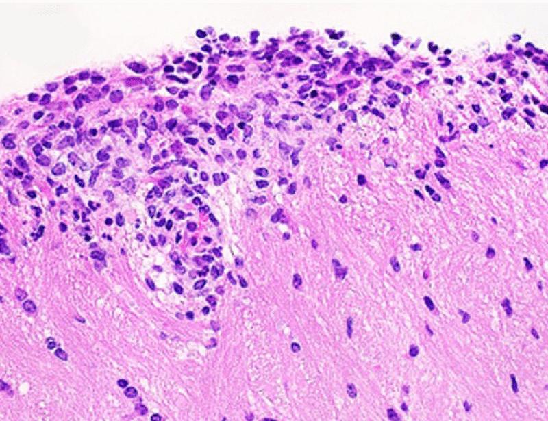 An adaptive cellular source of IL-17A and IL-17F is critical for the induction of experimental autoimmune encephalomyelitis | Science Immunology