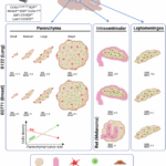 Brain metastases exhibit distinct spatial patterns of resident and infiltrating macrophages