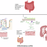 Drug-induced inflammatory colitis: a review of novel agents