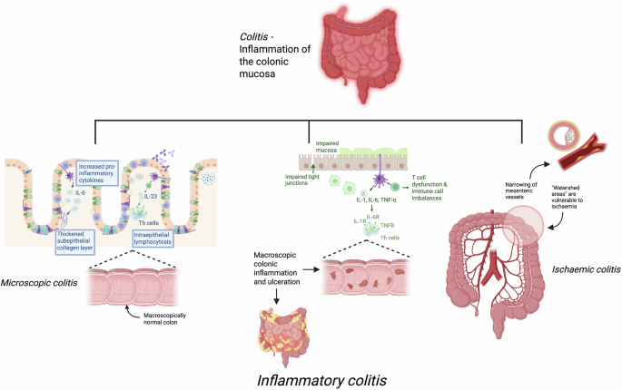 Drug-induced inflammatory colitis: a review of novel agents