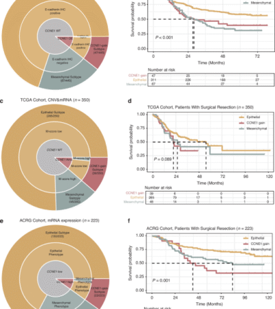 Lethal clinical outcome and immune desert contexture in refractory gastric cancer harboring CCNE1 amplification and overexpression