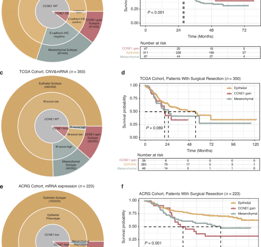 Lethal clinical outcome and immune desert contexture in refractory gastric cancer harboring CCNE1 amplification and overexpression