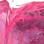 NIH-funded AI model predicts cancer survival from single-cell tumor data 
