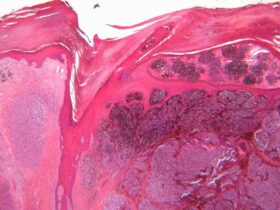 NIH-funded AI model predicts cancer survival from single-cell tumor data 