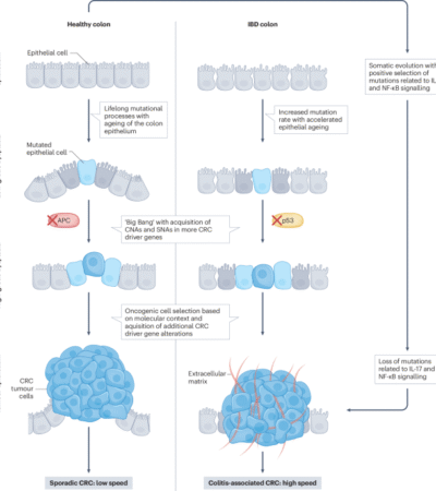 Pathophysiology of colitis-associated colorectal cancer