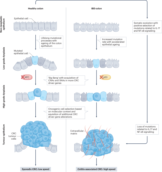 Pathophysiology of colitis-associated colorectal cancer