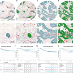 Significance of tumor infiltrating granulocytes and neutrophil extracellular traps in colorectal cancer