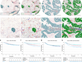 Significance of tumor infiltrating granulocytes and neutrophil extracellular traps in colorectal cancer