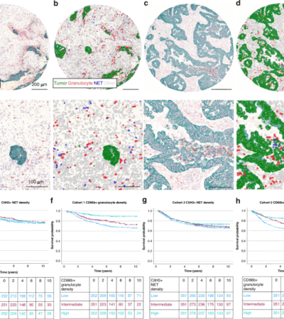 Significance of tumor infiltrating granulocytes and neutrophil extracellular traps in colorectal cancer