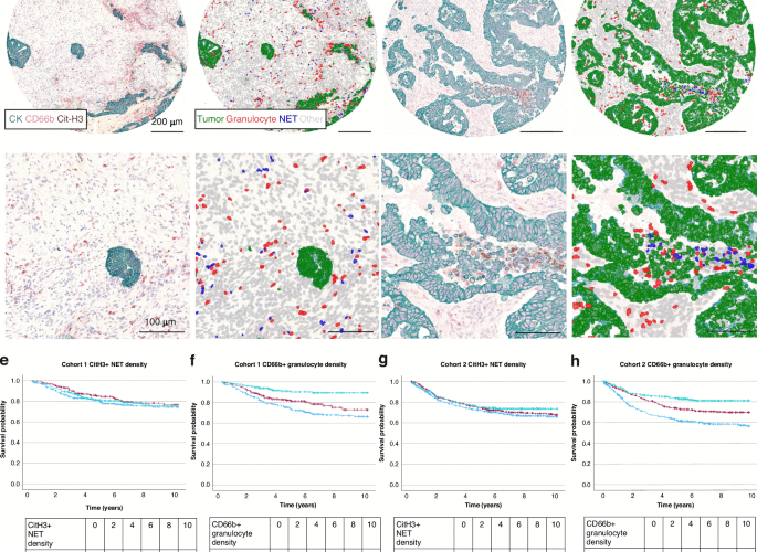 Significance of tumor infiltrating granulocytes and neutrophil extracellular traps in colorectal cancer